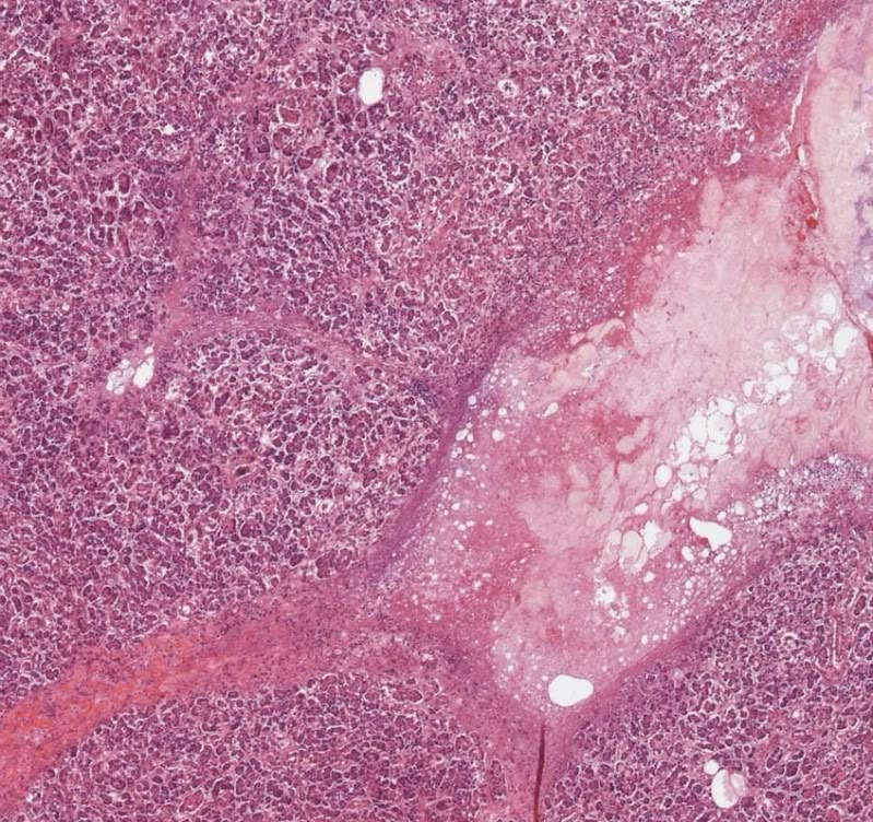 Histologie Akute Pankreatitis