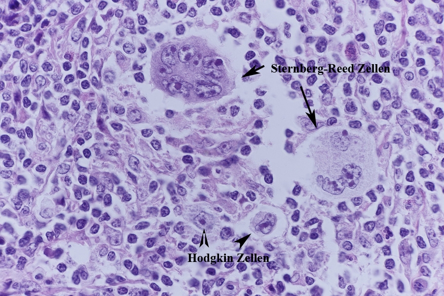Клетки рида штернберга. Клетки Рид-Березовского-Штернберга. Клетки Березовского-Штернберга гистология. Лимфогранулематоз гистология клетки Березовского Штернберга. Клетки Березовского Штернберга +цитология.